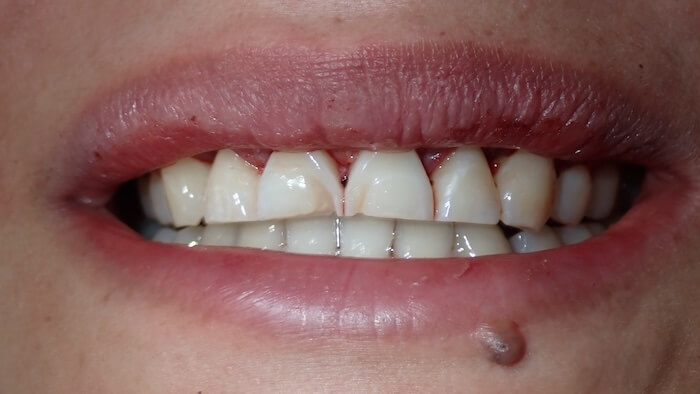 Liza Before
