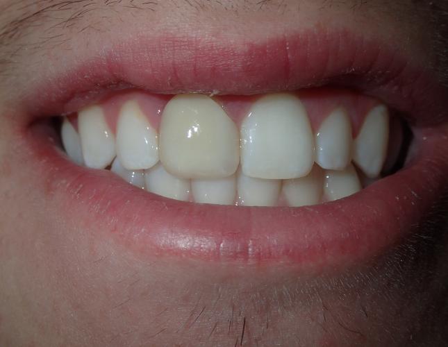 chazz_before_and_after1