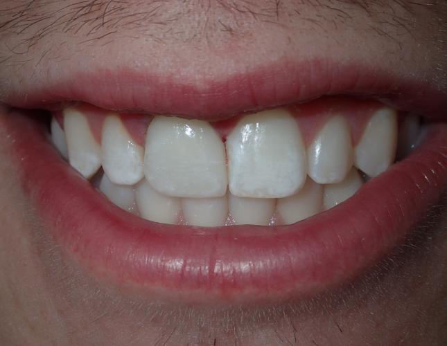 chazz_before_and_after2